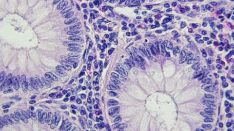 Colon cancer screening guideline change saved lives, studies say