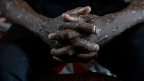 Congo says its mpox outbreak is over after 2 years and more than 2,200 suspected deaths