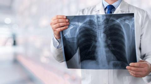 Deaths in Canada due to pneumonia rose by 20% in 2024