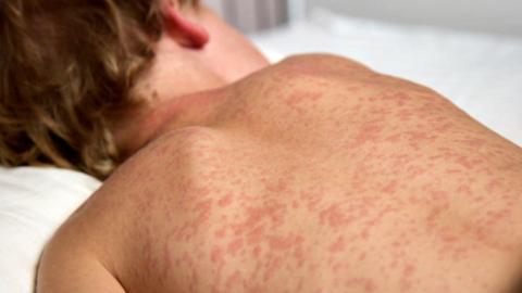 Dozens of new measles cases reported in Manitoba in 4th week of March