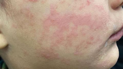 Experts call for measles 'immunization action plan' in Ontario