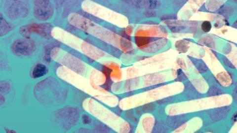 Fighting cancer with ... gold?!?!