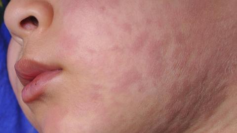 Four states announce more measles cases, exposures