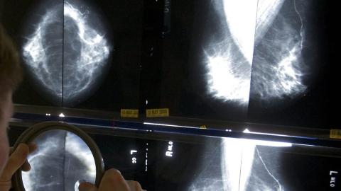 Global breast cancer cases expected to reach over 3.5 million by 2050