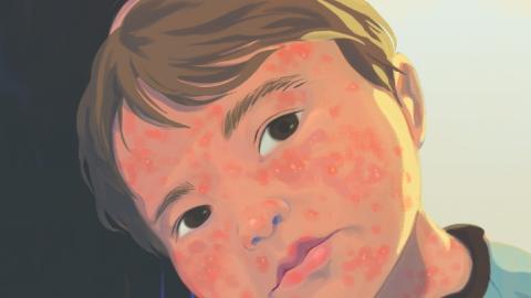 How Alberta Became the Epicentre of Canada's Measles Outbreak