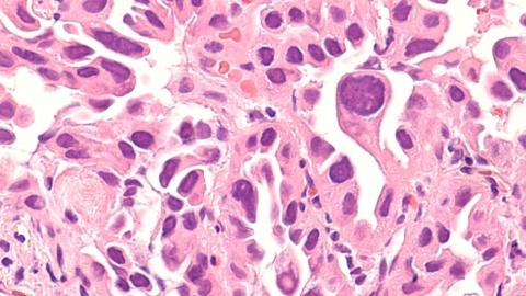 Lung cancer in 'never-smokers' draws new focus — and questions