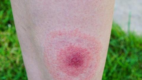 Lyme disease cases in England rise by more than 20% in a year