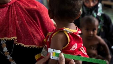 Malnutrition causes type 5 diabetes: experts