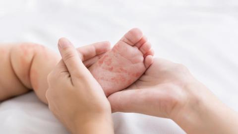 Manitoba health officials confirm 9 more measles cases