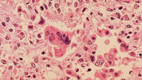 Manitoba's monthly measles number reaches three digits for the first time