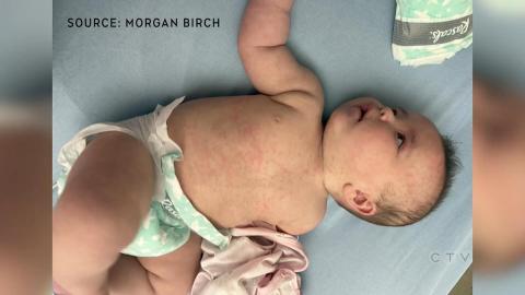 Measles continues to weaken this baby's immune system after infection