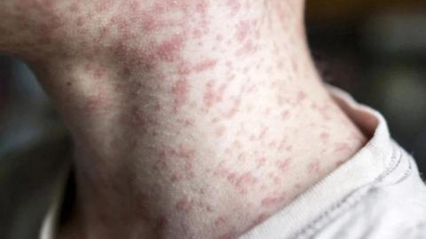 Measles exposure alert issued for Calgary airport, bus terminals around Alberta