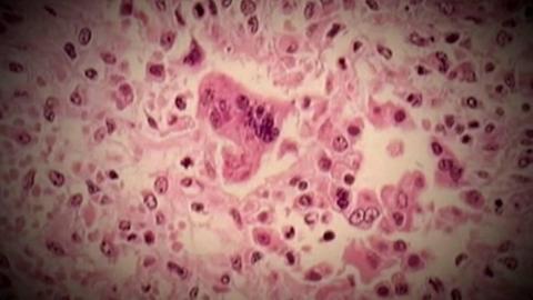 Measles exposures spike in northeast B.C., with another 29 suspected cases