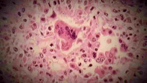 Measles outbreak in Portneuf, Que., grows to 7 cases