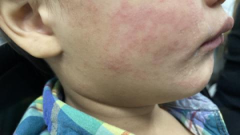 Measles spreading in South Carolina, with 99 new cases since Tuesday