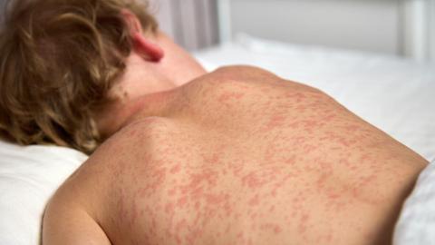 Measles vaccination rates falling provincewide, CBC analysis finds