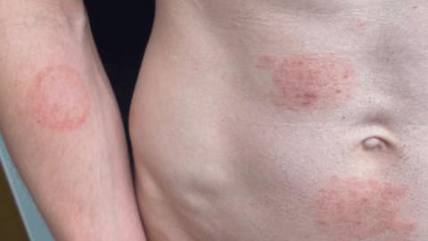 Minnesota health officials warn of sexually transmitted fungal infection outbreak