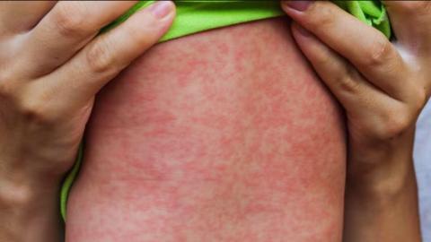 More than 3 dozen new measles cases recorded in Manitoba in late March, early April