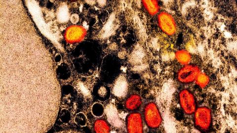 More than half of mpox patients in 2022 outbreak experienced lasting physical effects