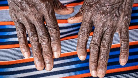 Mpox may be spreading asymptomatically, greatly increasing its threat, finds new study