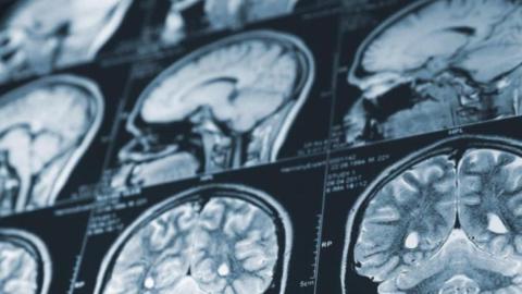 N.B. delays report on mystery brain illness, sends all data for federal review