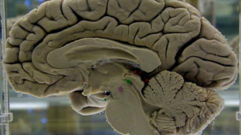 Neuropathologists urge Ottawa to bring back autopsy services for patients suspected of having fatal brain illness