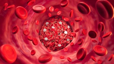 New research chips away at COVID-19 blood clot mystery