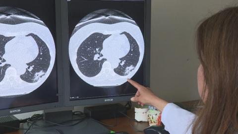 Nova Scotia's lung screening program finds dozens of cancer cases in first 2 years