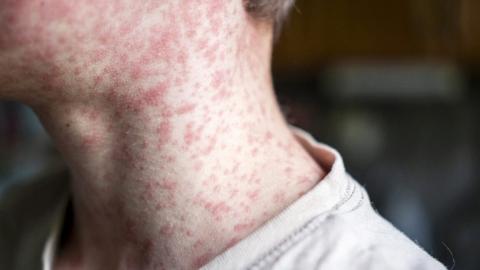 Over 250 people quarantined in South Carolina measles outbreak