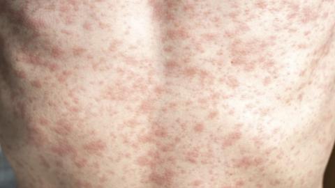 PAHO calls on Canada to do more to prevent measles