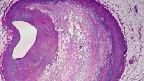 Plastic Discovered In More Than 50% of Plaques From Clogged Arteries