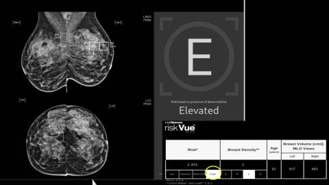 Radiologists catch more aggressive breast cancers by using AI to help read mammograms: study