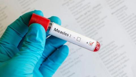 Red Deer seniors facility visitors warned of possible measles exposure