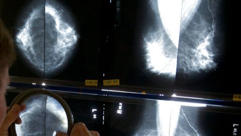Regions in Canada that face the highest rates of breast cancer, study reveals