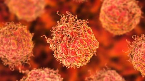 Researchers praise 'stunning' results of new prostate cancer treatment