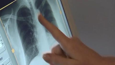 Sask. Health Authority defends tuberculosis response, management