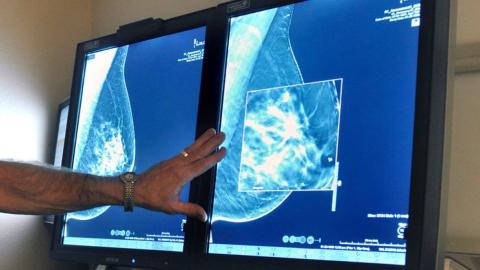 Sask. women 45+ can now self-refer for breast screening mammograms, but awareness, capacity issues continue