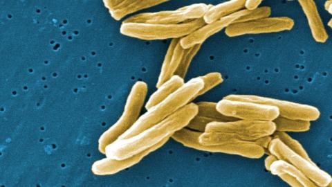 Saskatchewan has some of the highest tuberculosis rates in the country