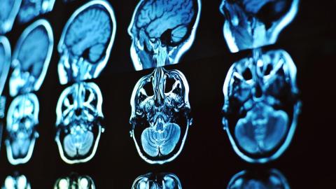 Scientists finally unveil what's behind long COVID brain fog