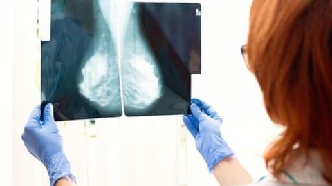 Simple blood test can predict which breast cancer treatment will work best, study finds