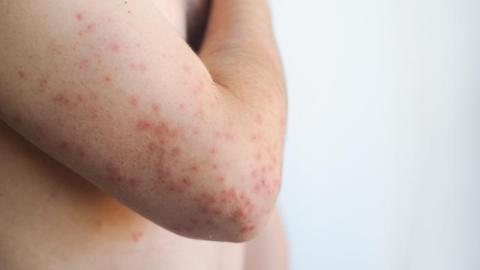 South Carolina measles outbreak expands by 200+, reaches 646 cases