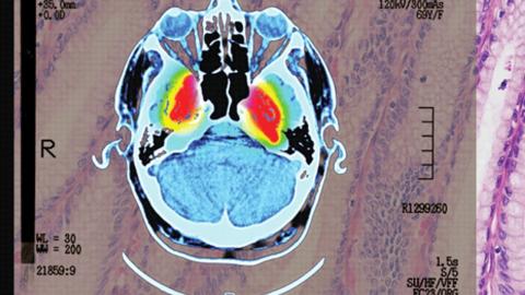'Strong evidence' of lowered dementia risk: the benefits of shingles vaccination