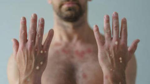 Tpoxx doesn't improve on placebo in achieving key mpox outcomes, phase 3 trial concludes