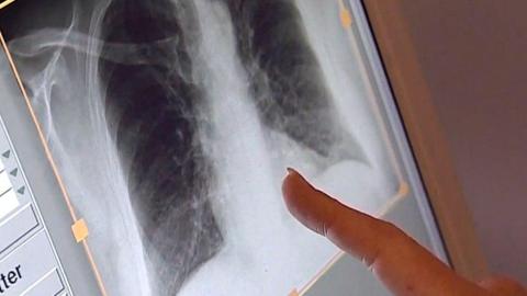 Tuberculosis cases rising in Montreal, other parts of Quebec