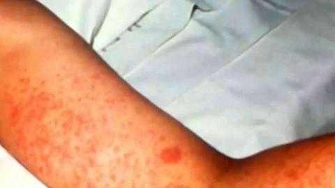 Two new measles cases confirmed in Quebec