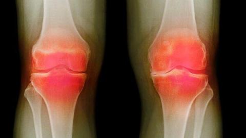U.S. Federal Agency Unveils Three Potential Osteoarthritis Treatments