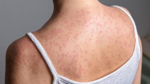 US 'highly likely' to lose measles elimination status this fall, analysis warns