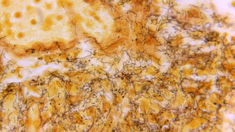 US rates of syphilis in pregnancy are climbing