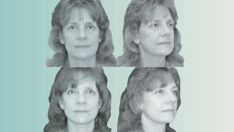 What is 'Ozempic face'? Side effect driving cosmetic surgery