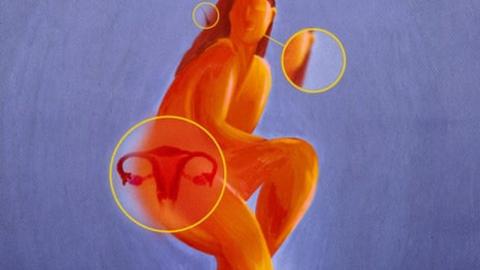 What is PCOS, what are the symptoms and treatment, and why is it being renamed PMOS?
